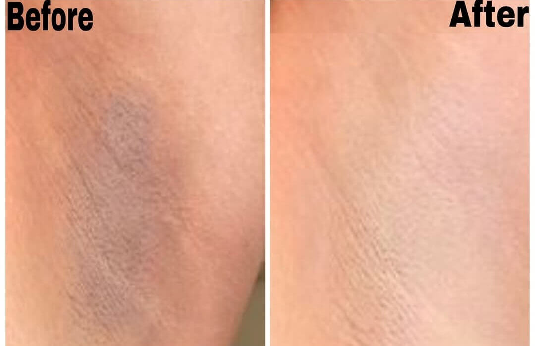 رفع موهای زائد با لیزر