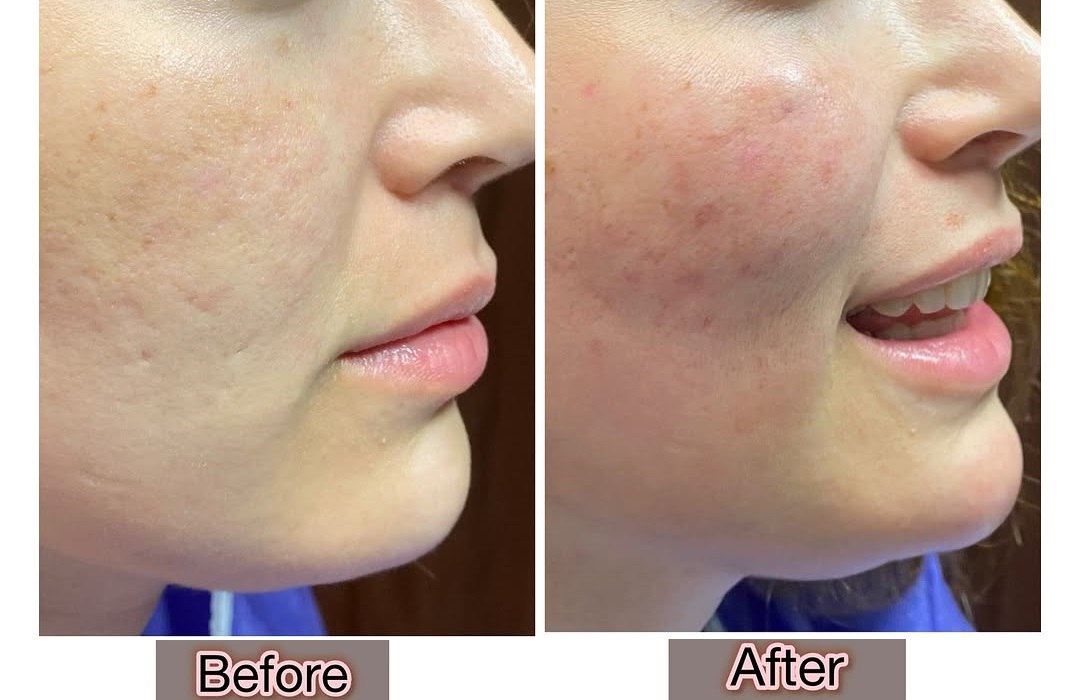 اصلاح و حجم دهی گونه با تزریق چربی