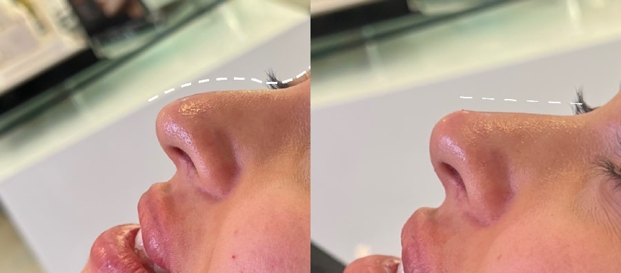 بوتاکس بینی