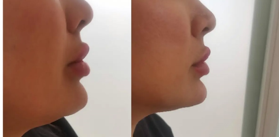 بوتاکس زاویه فک