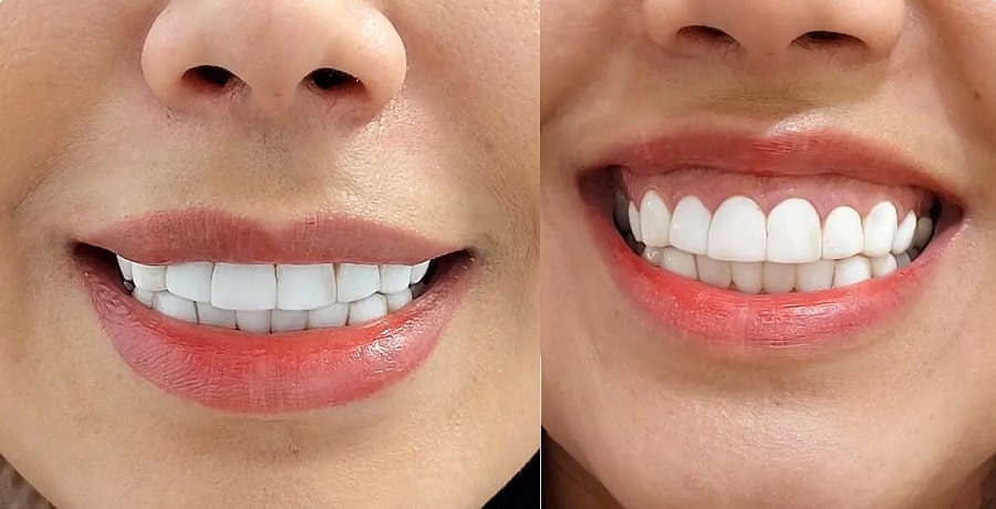 بوتاکس لبخند لثه ای