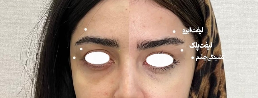 بوتاکس لیفت ابرو