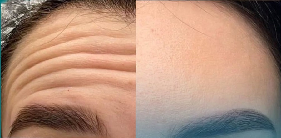 بوتاکس پیشانی