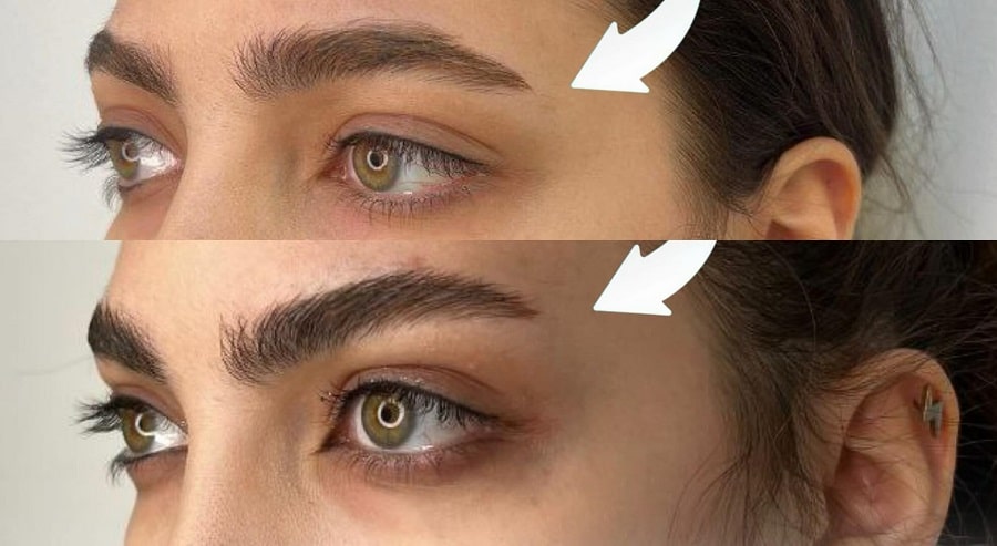 بوتاکس چشم گربه ای