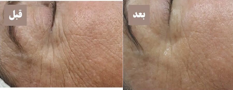 فشیال ضد پیری