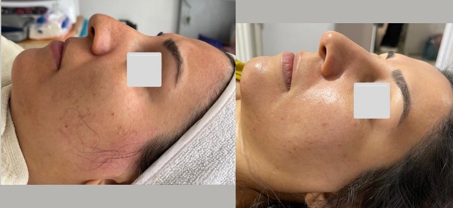 فشیال کلاسیک