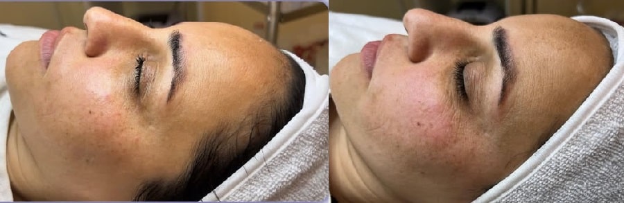 فیشیال آبرسان