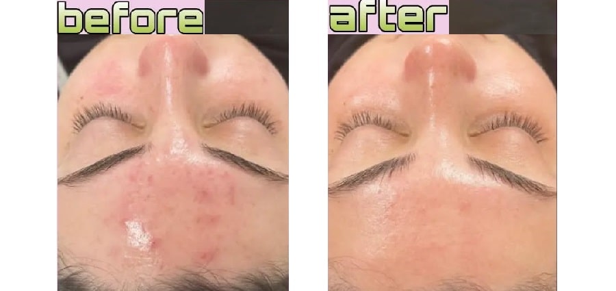 فیشیال آکنه