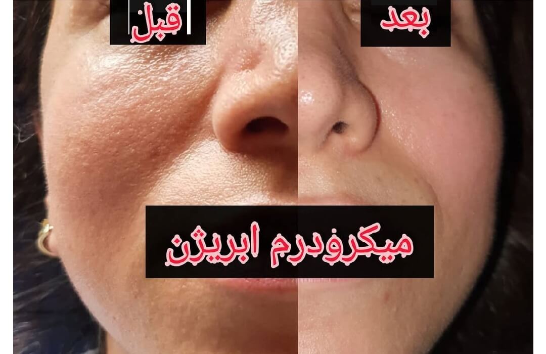 میکرودرم ابریژن