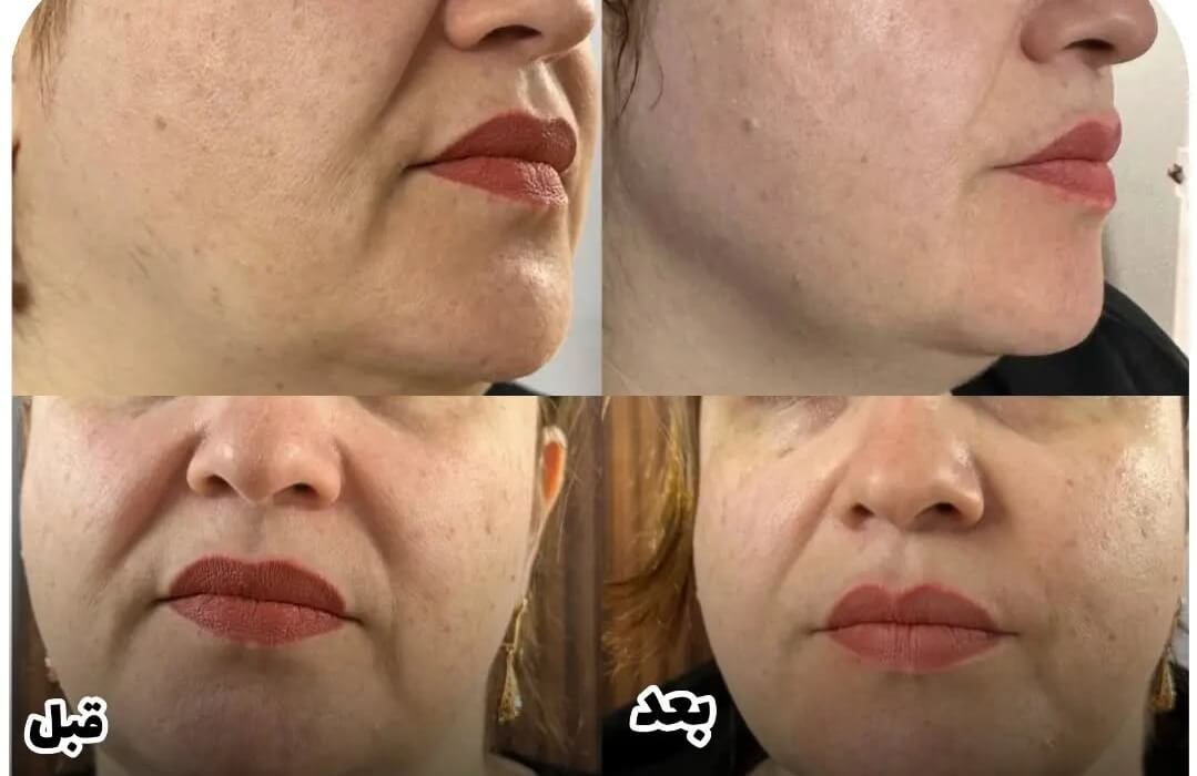 هایفوتراپی