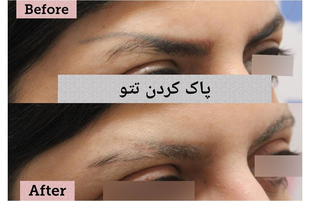 پاک کردن تتو