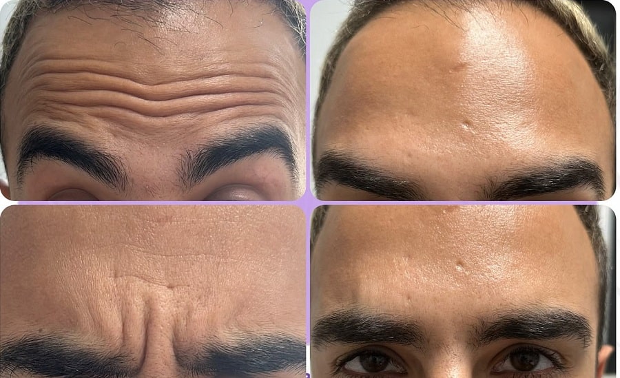 کاهش چین و چروک