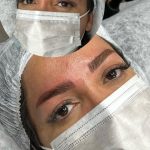 میکروبلیدینگ و فیبروز ابرو