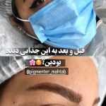 میکروبلیدینگ و فیبروز ابرو