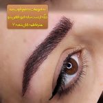 میکروبلیدینگ و فیبروز ابرو