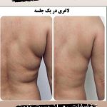 خدمات لاغری کلینیک زیبایی خورشید کرج 8