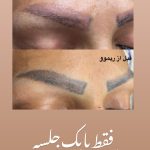 پاک کردن تتو