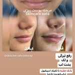 فیشیال صورت