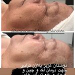 فیشیال صورت