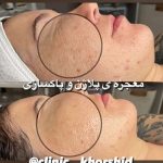 فیشیال صورت