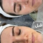 فیشیال صورت