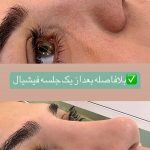 فیشیال صورت