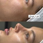 فیشیال صورت