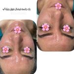 فیشیال صورت