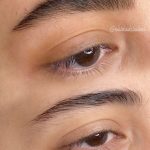 میکروبلیدینگ و فیبروز ابرو