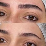 میکروبلیدینگ و فیبروز ابرو