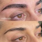 میکروبلیدینگ و فیبروز ابرو