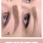 میکروبلیدینگ و فیبروز ابرو