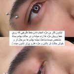 میکروبلیدینگ و فیبروز ابرو