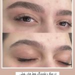 میکروبلیدینگ و فیبروز ابرو