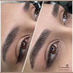 میکروبلیدینگ و فیبروز ابرو