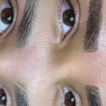 میکروبلیدینگ و فیبروز ابرو