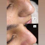 فیشیال صورت