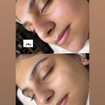 فیشیال صورت