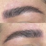 میکروبلیدینگ و فیبروز ابرو