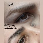 پاک کردن تتو