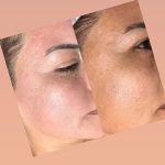 فیشیال صورت