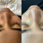 فیشیال صورت