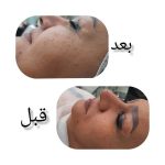 فیشیال صورت