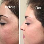 میکرونیدلینگ