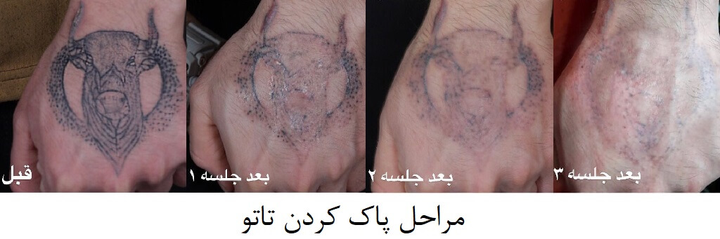 پاک کردن تاتو