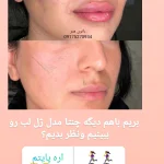 تزریق ژل و فیلر سالن زیبایی بانوی هنر بوشهر