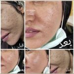 میکرونیدلینگ سالن زیبایی بانوی هنر بوشهر