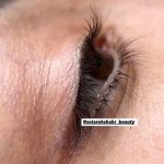 پاک کردن تتو