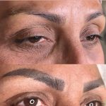 پاک کردن تتو