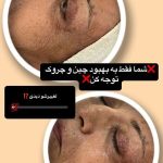 فیشیال صورت